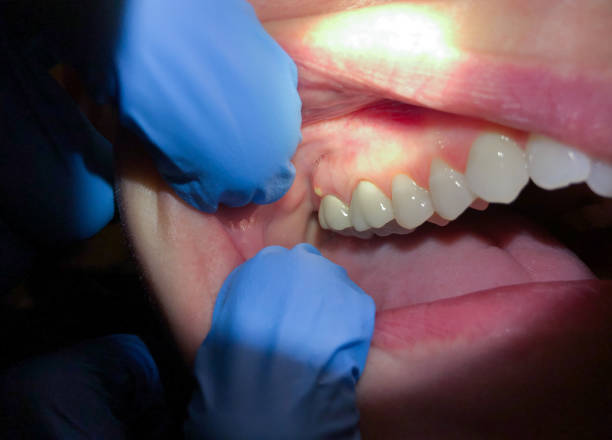 Best Emergency Wisdom Teeth Removal in Dripping Springs, TX